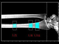 骨塩定量検査(骨密度測定)モニター画像2