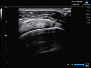 SNiBLEで撮影した肩腱板断裂