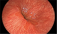 上部消化管内視鏡検査(胃カメラ) モニター画像